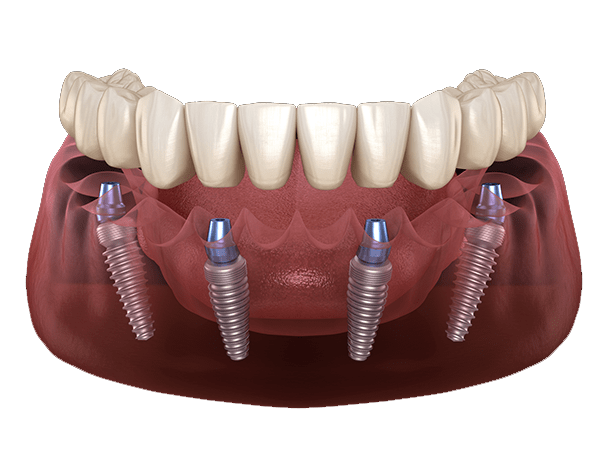 All-on-4® Dental Implants Southampton