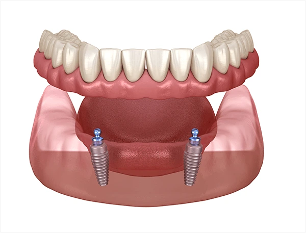 Denture w/ Implants